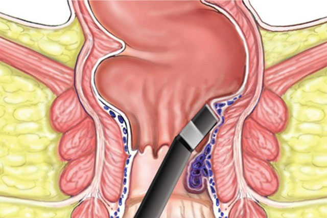 Cryosurgery for Piles